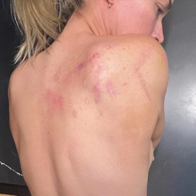 RHOBH Alum Teddi Mellencamp s Battle With Melanoma Cancer Diagnosis Surgeries Treatment Updates 287