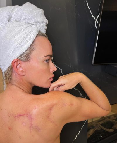 RHOBH Alum Teddi Mellencamp s Battle With Melanoma Cancer Diagnosis Surgeries Treatment Updates 288